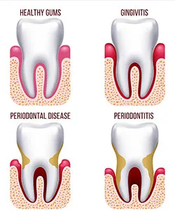 periodontal treatments