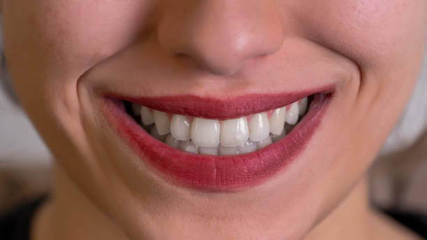 a woman confidently smiling, showcasing her natural-looking veneers